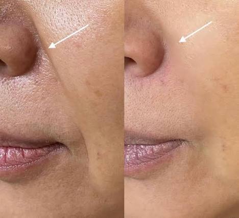 Antes e depois do Volnewmer: firmeza e textura da pele na região média da face