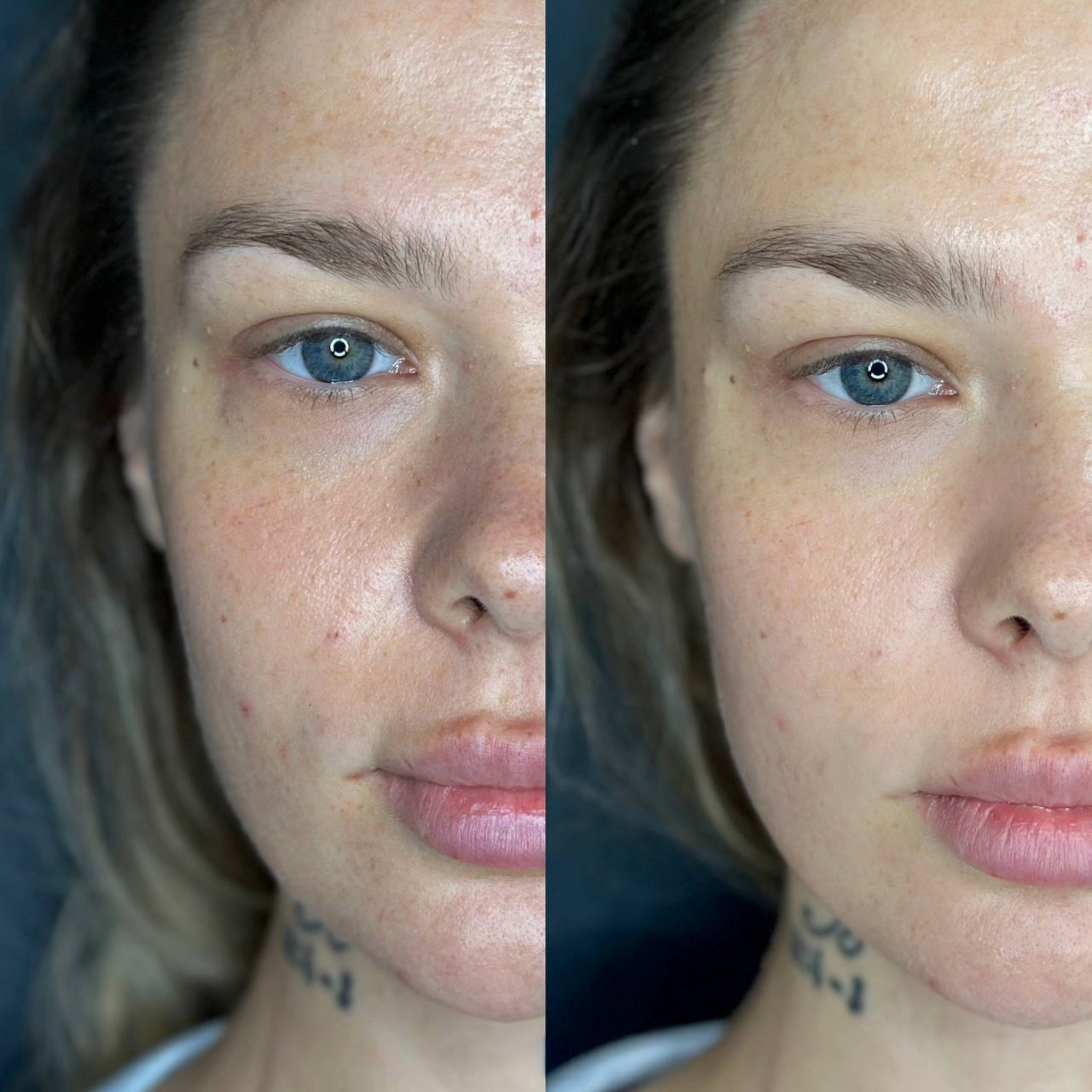 Antes e depois do Volnewmer: qualidade e viço da pele do rosto