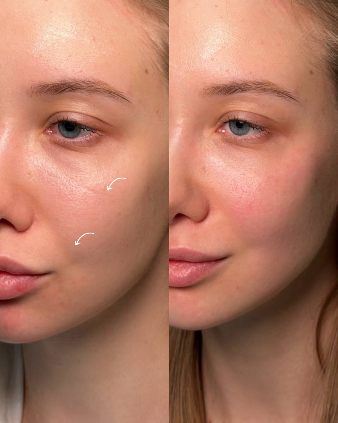Antes e depois do Volnewmer: contorno facial e sustentação da pele