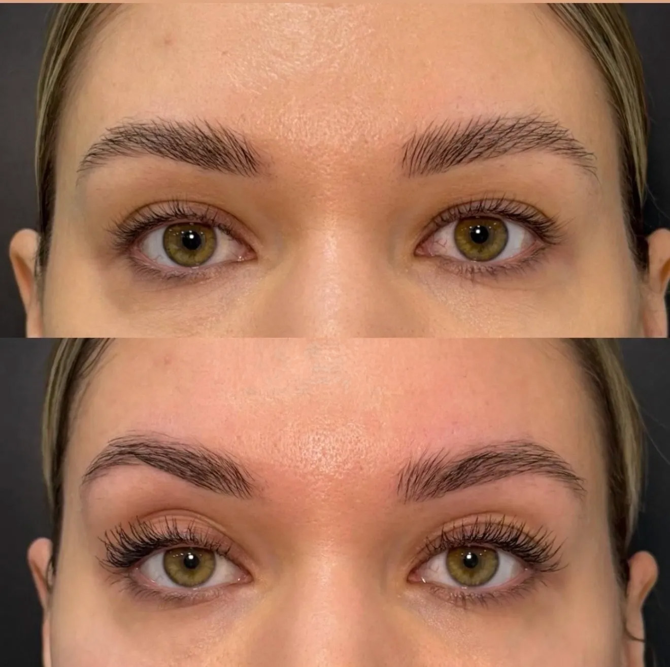 Antes e depois do Volnewmer: região do olhar e sustentação da sobrancelha